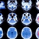 brain scan images Queener Law