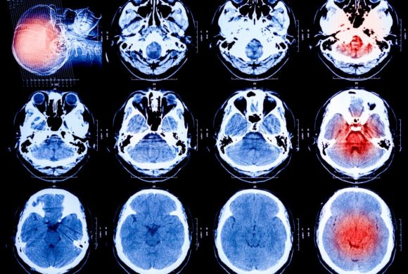 brain scan images Queener Law